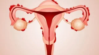 Marie-Blanche Tchetgen: It's Not Always a UTI, The Bladder Side of Endometriosis!