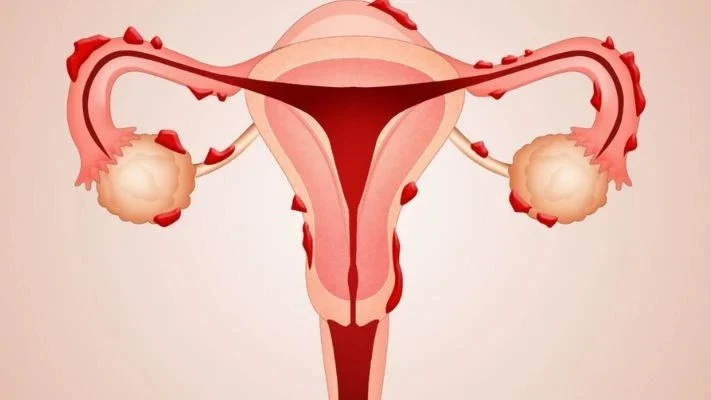 Marie-Blanche Tchetgen: It’s Not Always a UTI, The Bladder Side of Endometriosis!