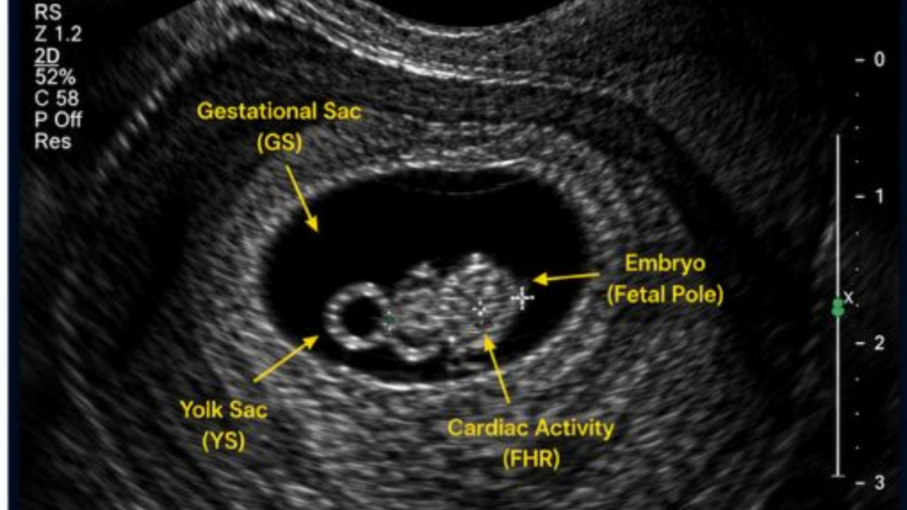 Fajr Adil: Understanding Fetal Heartbeat on First Trimester Ultrasound