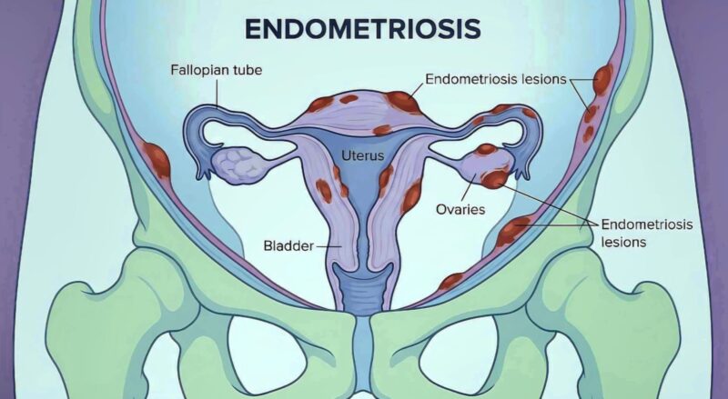 Marco Zaccaria: The Three Faces of Endometriosis, What Every Woman Should Know?