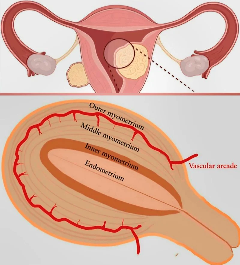 Marco Zaccaria: Even Small Growths Close to the Endometrium Can Significantly Impact Reproductive Health