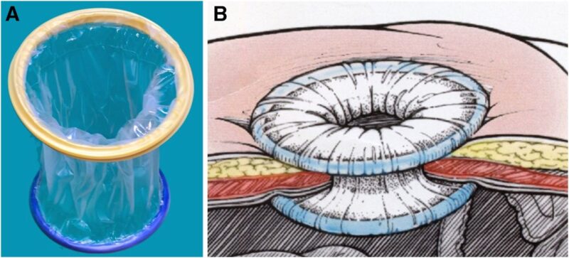 Christopher Robinson: AJOG Expert Review in Cesarean – OR/Mobius Elastic Abdominal Retractor
