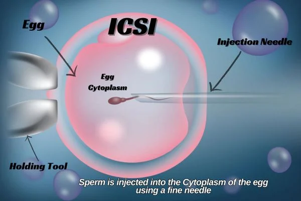 Somya Jha։ ICSI – 1 Sperm, 1 Egg, 1 Tiny Needle