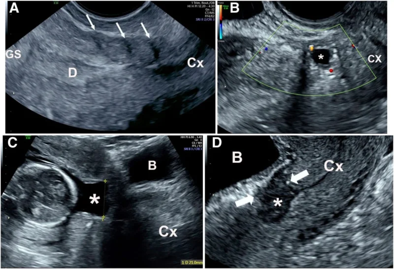 Christopher Robinson։ Ultrasound Images of Scar and Cesarean Scar Defects