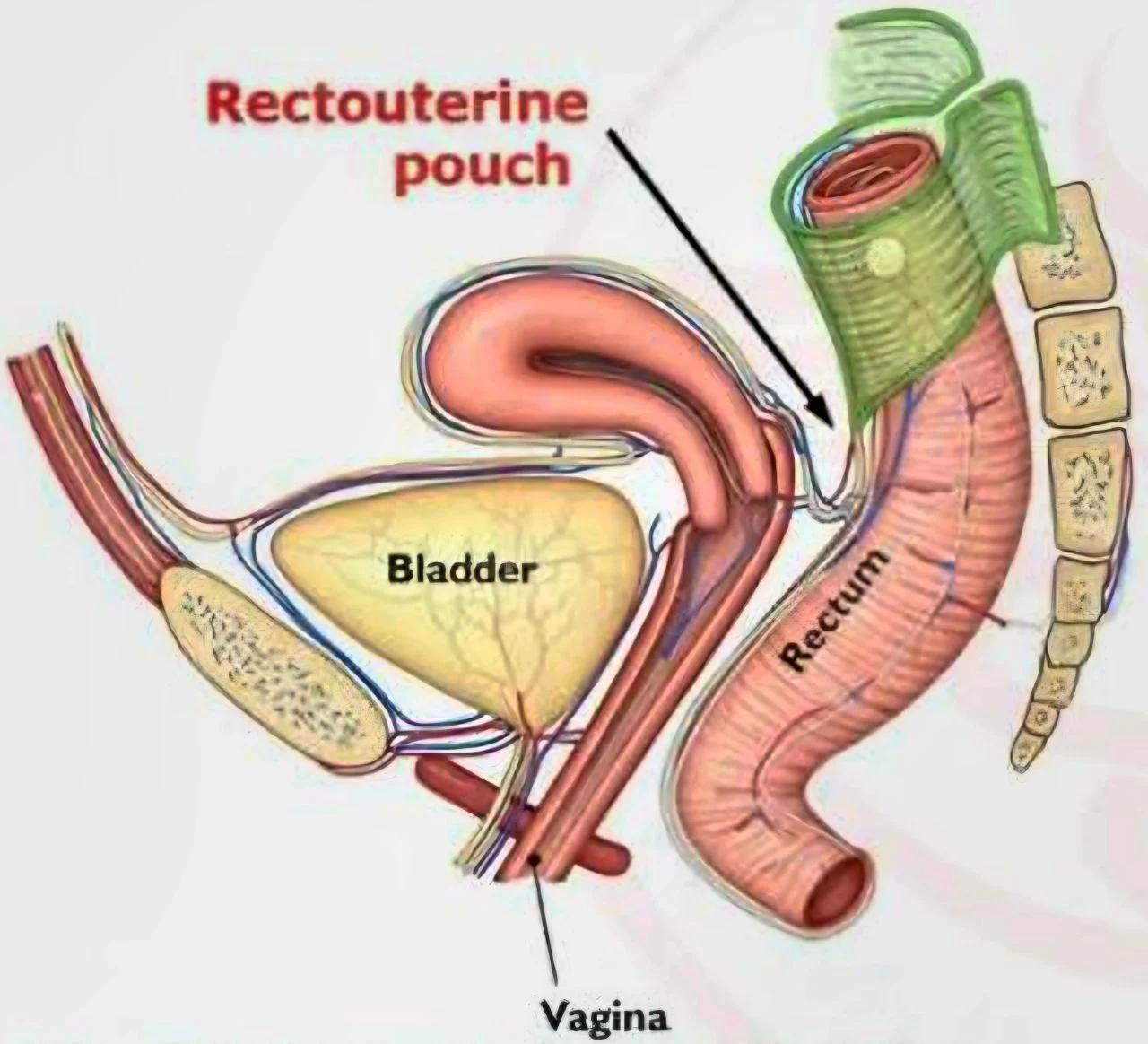 Marco Zaccaria։ What is the Relationship Between Douglas’s Canal and Uterine Fibroids
