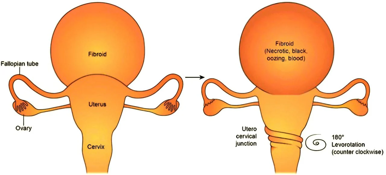 Marco Zaccaria։ What Is a Twisted Uterus and What Impact Can It Have?