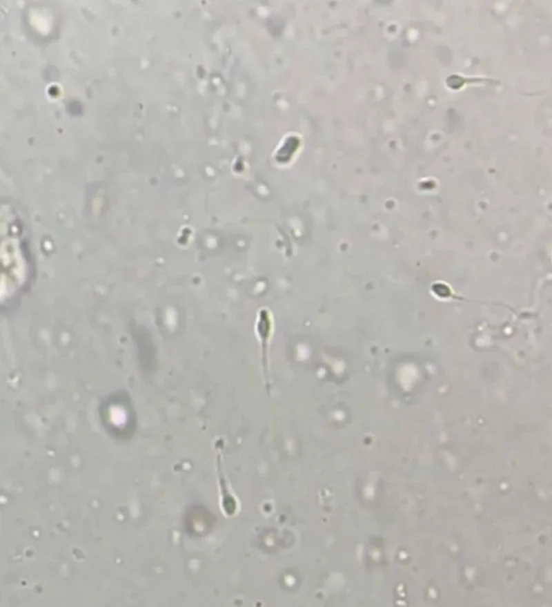 Rahul Singh Parmar։ IVF Lab QC – Morphological Sperm Selection and DFI Management