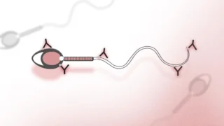 Understanding the Impact of Antisperm Antibodies on Fertility - Fertility Plus