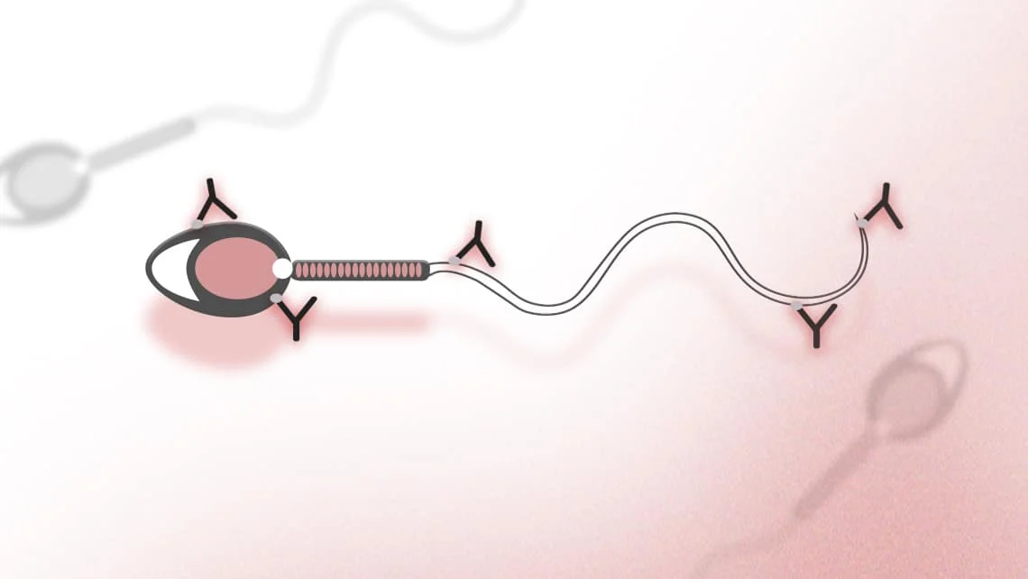 Understanding the Impact of Antisperm Antibodies on Fertility – Fertility Plus