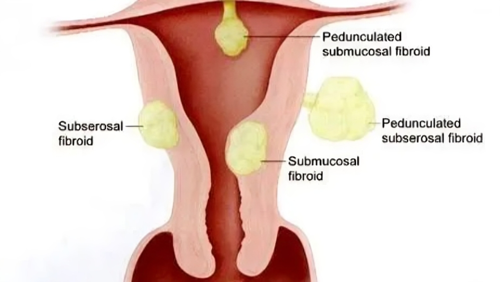 Fibroids
