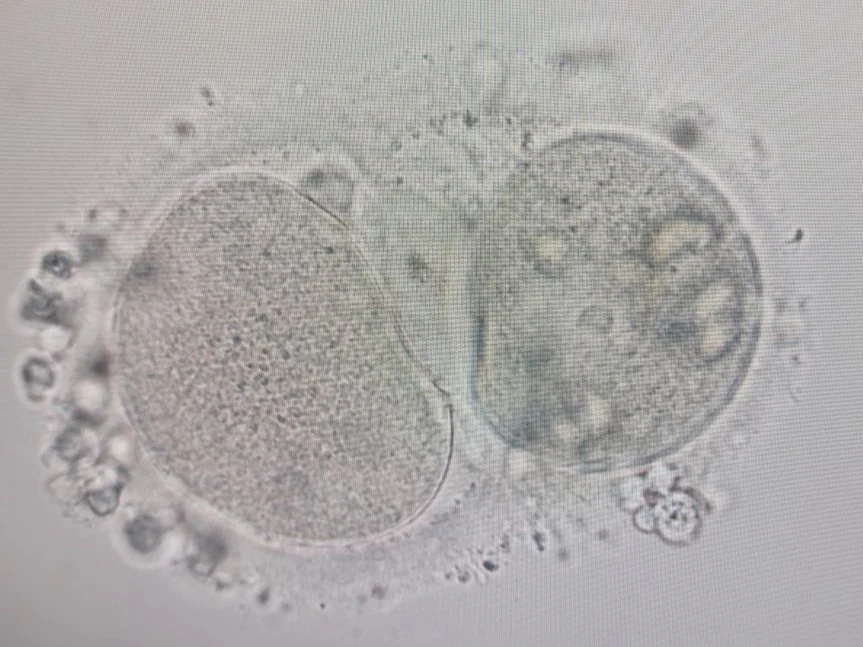 Entisar Elmuntasar: 2 Oocytes Within 1 Zona Pellucida