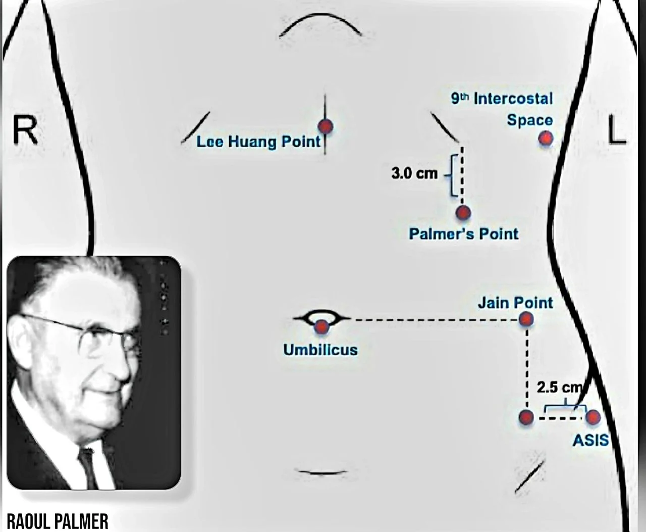 Marco Zaccaria։ The Gynecologist Who Made a Decisive Contribution to Modern Laparoscopy