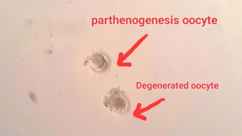 Zeynab Kazemianpour: 2 Unusual Oocytes Observed Before ICSI