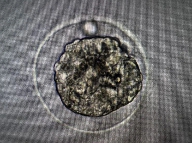 IVF Case