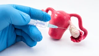 The Difference Between Ovulation Induction and Ovarian Stimulation - Fertility Plus