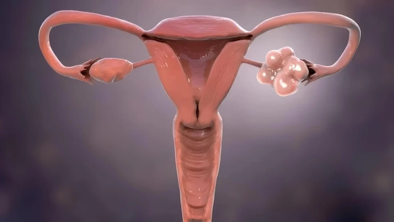 Breaking Another PMOS Myth – PCOS Awareness Association