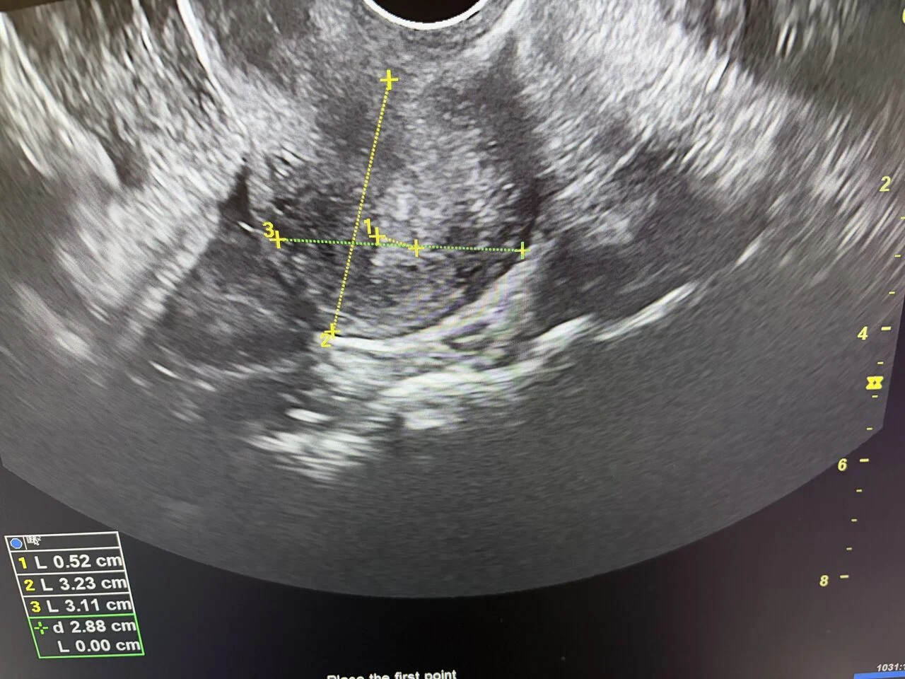 Namita Kotia: When an IVF Cycle Takes an Unexpected Turn…