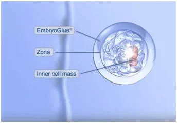 Somil Singhal: Method for Enhancing Embryo Implantation Using Embryo Glue and Its Importance