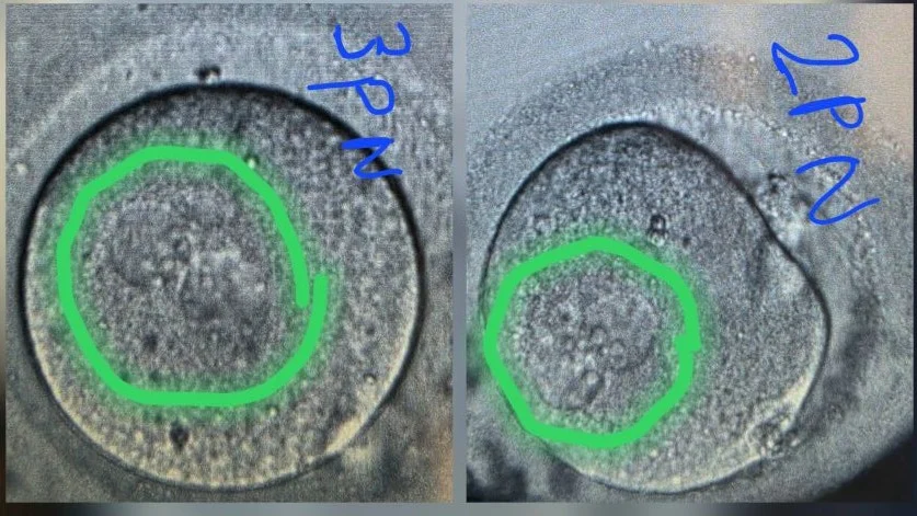 Arshhita A.: 3PN Oocytes – Why Does Fertilization Go Wrong?